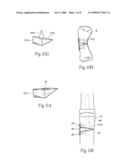 Devices, systems and methods for re-alignment of bone diagram and image