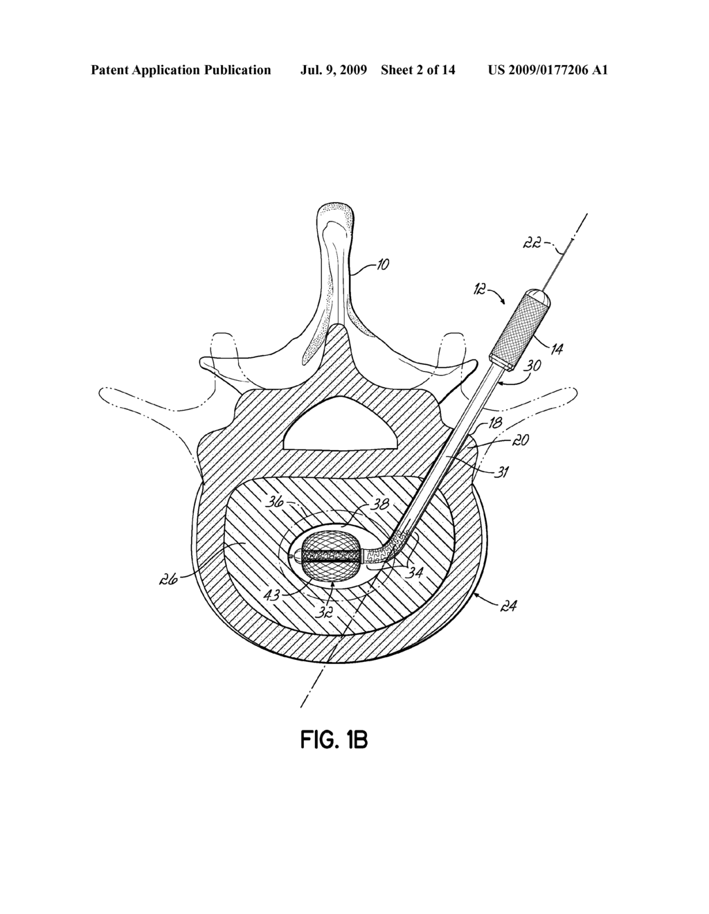 INSTRUMENTS, IMPLANTS, AND METHODS FOR FIXATION OF VERTEBRAL COMPRESSION FRACTURES - diagram, schematic, and image 03