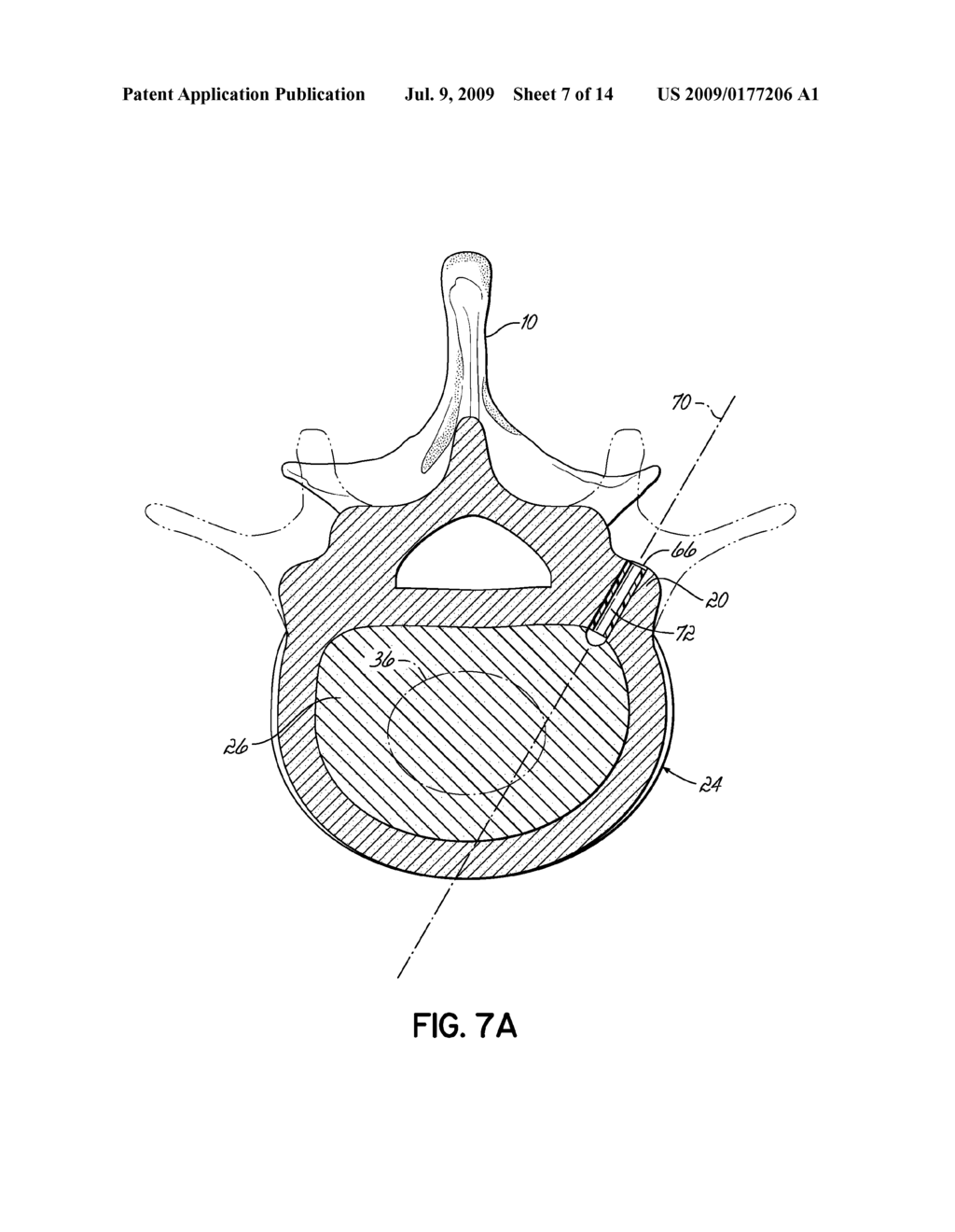 INSTRUMENTS, IMPLANTS, AND METHODS FOR FIXATION OF VERTEBRAL COMPRESSION FRACTURES - diagram, schematic, and image 08