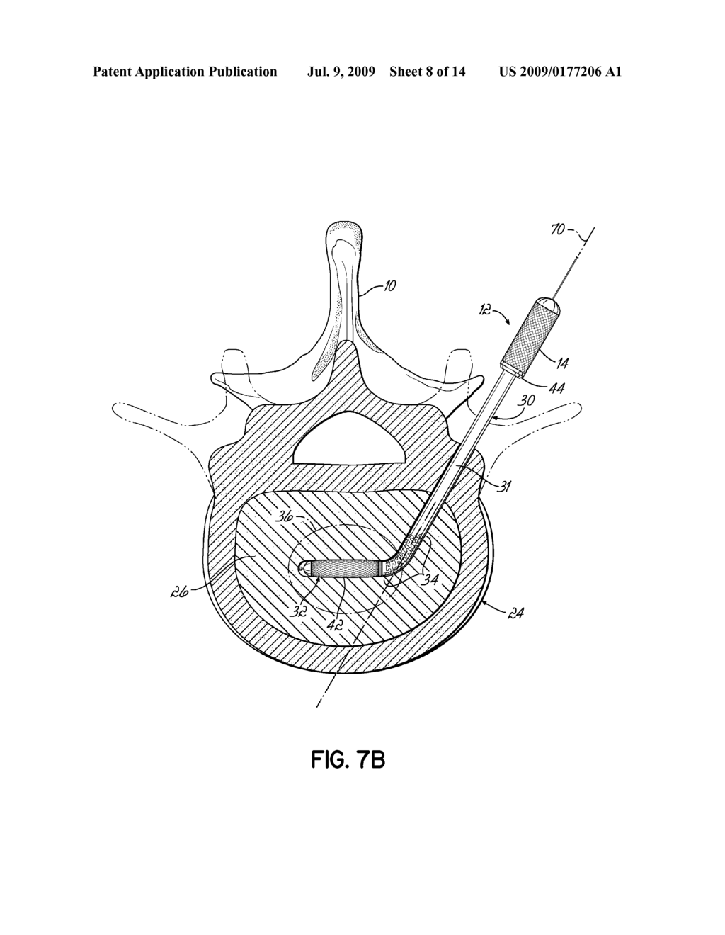 INSTRUMENTS, IMPLANTS, AND METHODS FOR FIXATION OF VERTEBRAL COMPRESSION FRACTURES - diagram, schematic, and image 09