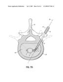 INSTRUMENTS, IMPLANTS, AND METHODS FOR FIXATION OF VERTEBRAL COMPRESSION FRACTURES diagram and image