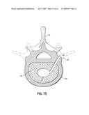 INSTRUMENTS, IMPLANTS, AND METHODS FOR FIXATION OF VERTEBRAL COMPRESSION FRACTURES diagram and image