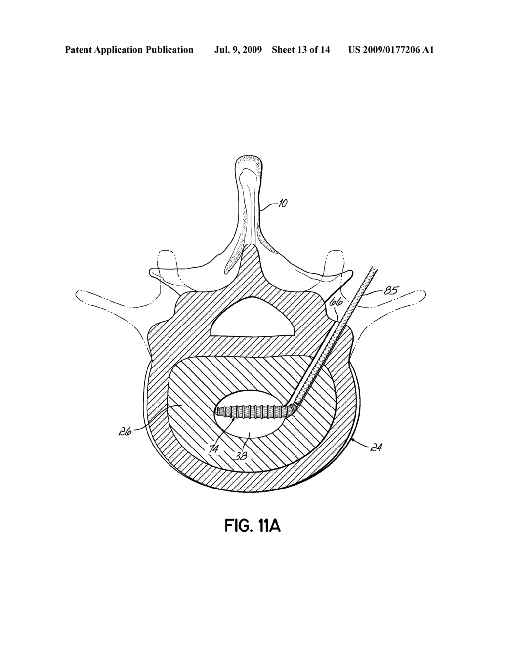 INSTRUMENTS, IMPLANTS, AND METHODS FOR FIXATION OF VERTEBRAL COMPRESSION FRACTURES - diagram, schematic, and image 14