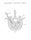 Apparatus and methods for bone, tissue and duct dilatation diagram and image