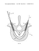 Apparatus and methods for bone, tissue and duct dilatation diagram and image