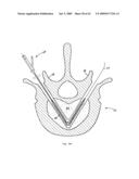 Apparatus and methods for bone, tissue and duct dilatation diagram and image