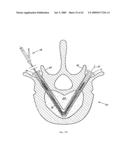 Apparatus and methods for bone, tissue and duct dilatation diagram and image