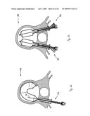 Apparatus and methods for bone, tissue and duct dilatation diagram and image