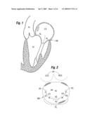 Degenerative Valvular Disease Specific Annuloplasty Rings diagram and image