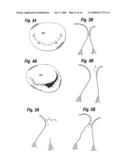 Degenerative Valvular Disease Specific Annuloplasty Rings diagram and image