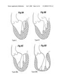 Degenerative Valvular Disease Specific Annuloplasty Rings diagram and image