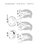 Degenerative Valvular Disease Specific Annuloplasty Rings diagram and image