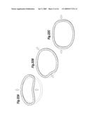 Degenerative Valvular Disease Specific Annuloplasty Rings diagram and image