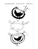 IMPLANTATION SYSTEM FOR ANNULOPLASTY RINGS diagram and image