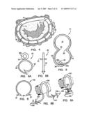 IMPLANTATION SYSTEM FOR ANNULOPLASTY RINGS diagram and image