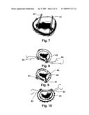 IMPLANTATION SYSTEM FOR ANNULOPLASTY RINGS diagram and image