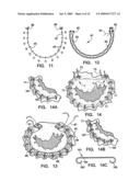 IMPLANTATION SYSTEM FOR ANNULOPLASTY RINGS diagram and image