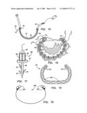 IMPLANTATION SYSTEM FOR ANNULOPLASTY RINGS diagram and image