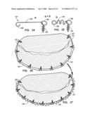 IMPLANTATION SYSTEM FOR ANNULOPLASTY RINGS diagram and image