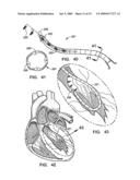 IMPLANTATION SYSTEM FOR ANNULOPLASTY RINGS diagram and image