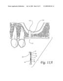 Flexible tooling for use in maxillary sinus elevation procedures and method of using the same diagram and image