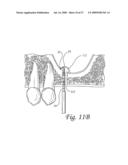 Flexible tooling for use in maxillary sinus elevation procedures and method of using the same diagram and image