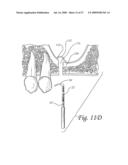 Flexible tooling for use in maxillary sinus elevation procedures and method of using the same diagram and image