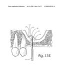 Flexible tooling for use in maxillary sinus elevation procedures and method of using the same diagram and image