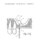 Flexible tooling for use in maxillary sinus elevation procedures and method of using the same diagram and image