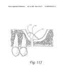 Flexible tooling for use in maxillary sinus elevation procedures and method of using the same diagram and image