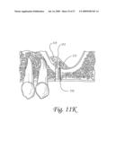 Flexible tooling for use in maxillary sinus elevation procedures and method of using the same diagram and image