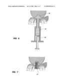 ASSEMBLY FOR LIFTING THE SINUS MEMBRANE FOR USE IN DENTAL IMPLANT SURGERY diagram and image