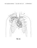 DEVICES, METHODS AND SYSTEMS FOR ESTABLISHING SUPPLEMENTAL BLOOD FLOW IN THE CIRCULATORY SYSTEM diagram and image