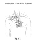 DEVICES, METHODS AND SYSTEMS FOR ESTABLISHING SUPPLEMENTAL BLOOD FLOW IN THE CIRCULATORY SYSTEM diagram and image