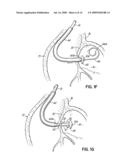 DEVICES, METHODS AND SYSTEMS FOR ESTABLISHING SUPPLEMENTAL BLOOD FLOW IN THE CIRCULATORY SYSTEM diagram and image