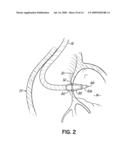 DEVICES, METHODS AND SYSTEMS FOR ESTABLISHING SUPPLEMENTAL BLOOD FLOW IN THE CIRCULATORY SYSTEM diagram and image