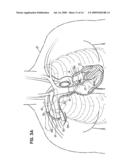 DEVICES, METHODS AND SYSTEMS FOR ESTABLISHING SUPPLEMENTAL BLOOD FLOW IN THE CIRCULATORY SYSTEM diagram and image