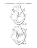 DEVICES, METHODS AND SYSTEMS FOR ESTABLISHING SUPPLEMENTAL BLOOD FLOW IN THE CIRCULATORY SYSTEM diagram and image