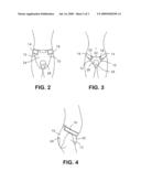 Absorbent Garment diagram and image