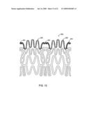 STENT WITH SELF-DEPLOYABLE PORTION HAVING WINGS OF DIFFERENT LENGTHS diagram and image