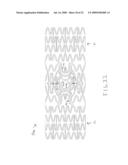 STENT WITH SELF-DEPLOYABLE PORTION HAVING WINGS OF DIFFERENT LENGTHS diagram and image