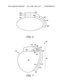 IMPLANTABLE MEDICAL DEVICE WITH ANTENNA diagram and image