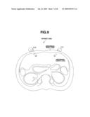 MEDICAL DEVICE AND PROCESS OF INSTALLING MEDICAL DEVICE IN PATIENT diagram and image