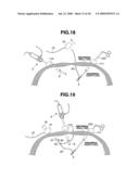 MEDICAL DEVICE AND PROCESS OF INSTALLING MEDICAL DEVICE IN PATIENT diagram and image