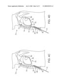 EPICARDIAL ACCESS AND TREATMENT SYSTEMS diagram and image