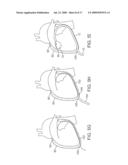 EPICARDIAL ACCESS AND TREATMENT SYSTEMS diagram and image