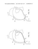 EPICARDIAL ACCESS AND TREATMENT SYSTEMS diagram and image