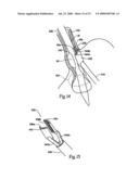 SURGICAL INSTRUMENTS AND TECHNIQUES FOR TREATING GASTRO-ESOPHAGEAL REFLUX DISEASE diagram and image