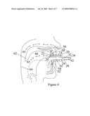 Treatment of obstructive sleep disorders diagram and image