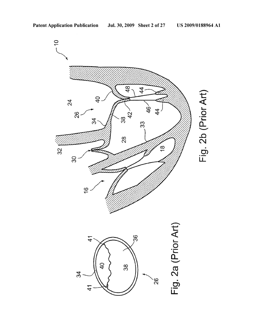 MEMBRANE AUGMENTATION, SUCH AS OF FOR TREATMENT OF CARDIAC VALVES, AND FASTENING DEVICES FOR MEMBRANE AUGMENTATION - diagram, schematic, and image 03